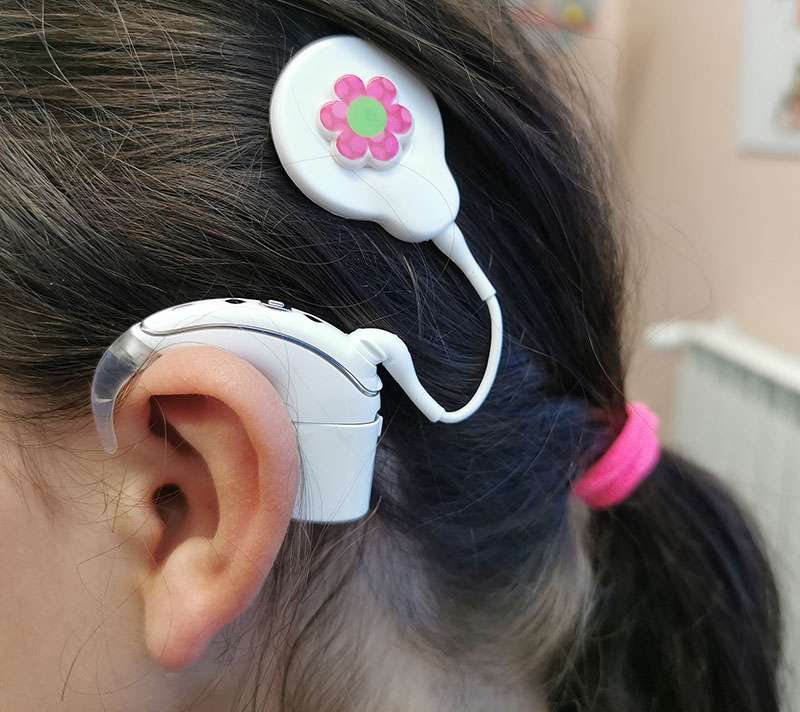 impiantococleareBurlo